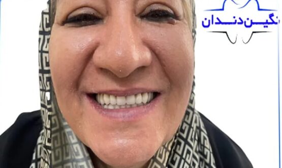 لیست و جدول قیمت دندان مصنوعی کامل، ژله ای، ثابت، متحرک، آلمانی، ایتالیایی