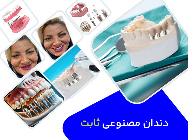 دندان مصنوعی ثابت