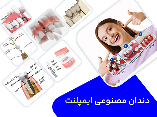 دندان مصنوعی ایمپلنت