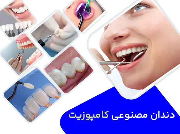 کامپوزیت دندان
