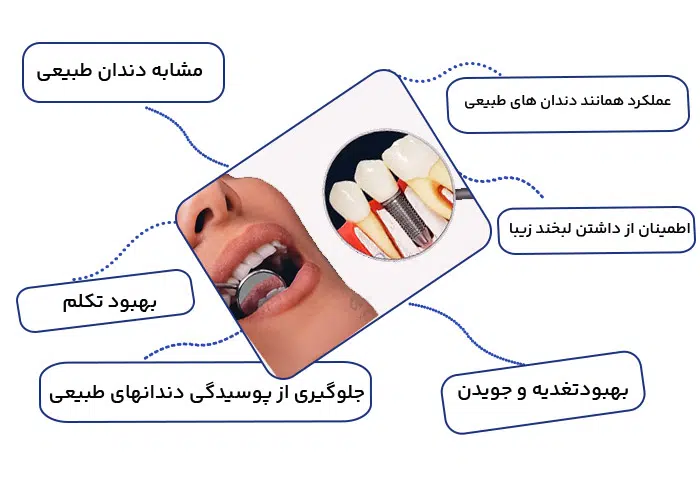 ایمپلنت دندان