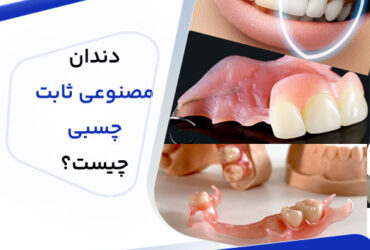 دندان مصنوعی ثابت چسبی چیست