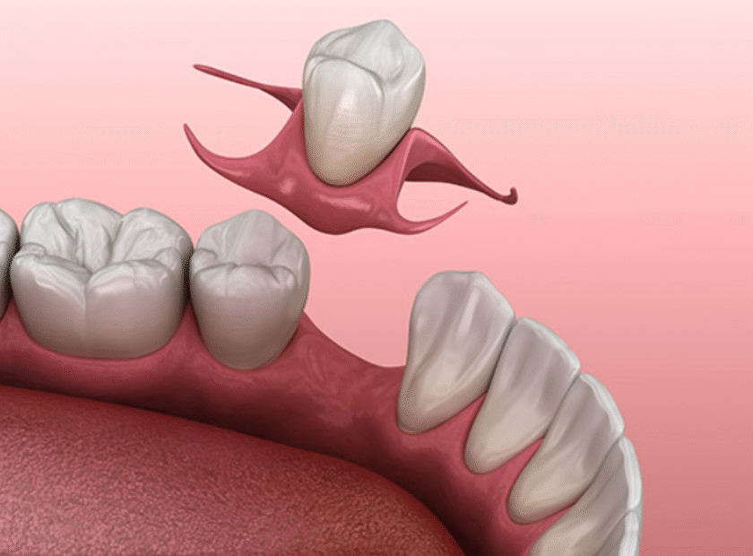 قیمت دندان مصنوعی تکی چسبی