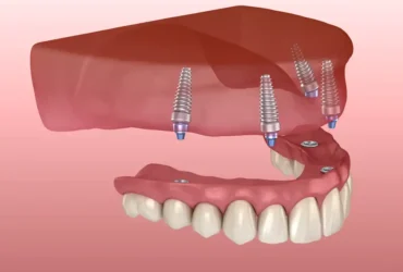 دندان مصنوعی ثابت بر پایه ایمپلنت