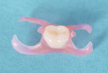 ساخت دندان مصنوعی تکی فوری در 5 ساعت