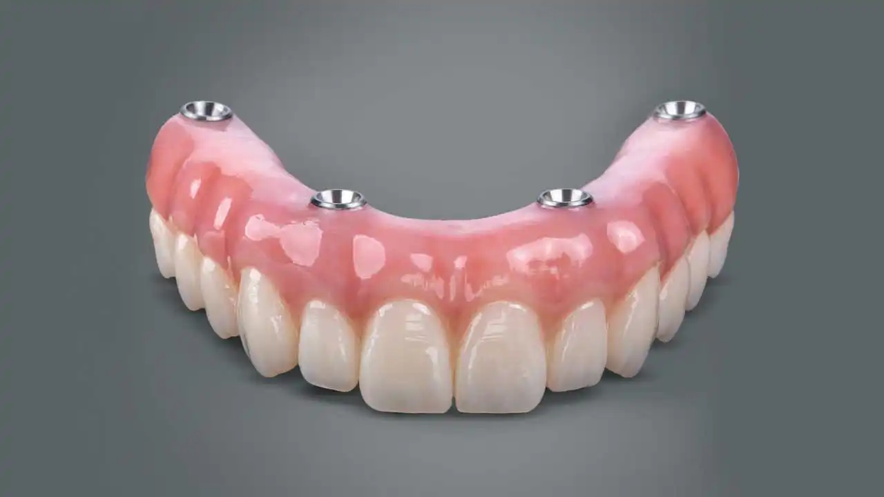 قیمت دندان مصنوعی متحرک بر پایه ایمپلنت