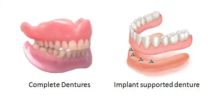 دندان مصنوعی ثابت بهتر است یا پروتز متحرک؟