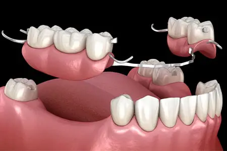 قیمت پروتز موقت دندان