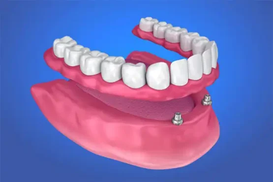 اوردنچر چست؟ هزینه و انواع اوردنچر در 1405